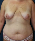 Feel Beautiful - Mommy Makeover San Diego Case 6 - Before Photo